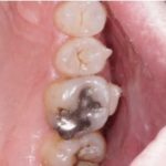 Remoción de amalgamas dentales