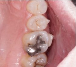 Remoció d’amalgames dentals